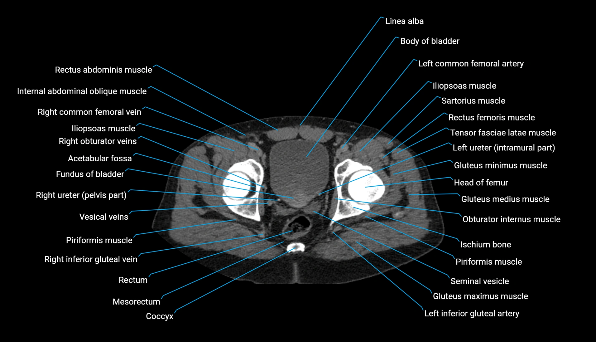 CT urogram axial cross sectional anatomy  labelled radiology image-00228.webp